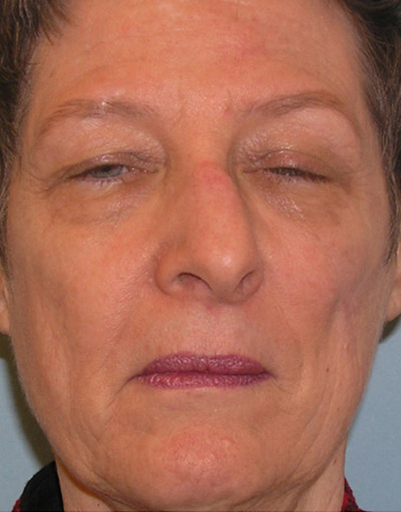Patient apxk__pRSdGPjwjedDuhig - Foundation Rhinoplasty Before & After Photos