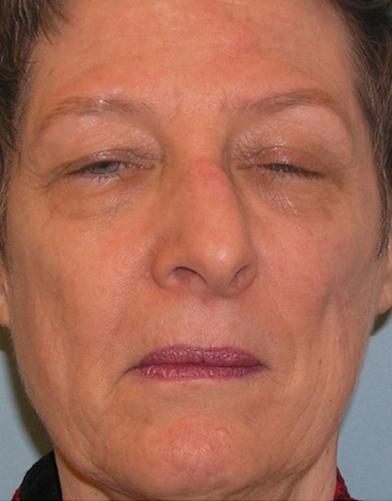 Foundation Rhinoplasty / Crooked Nose Before & After Gallery - Patient 400222 - Image 1