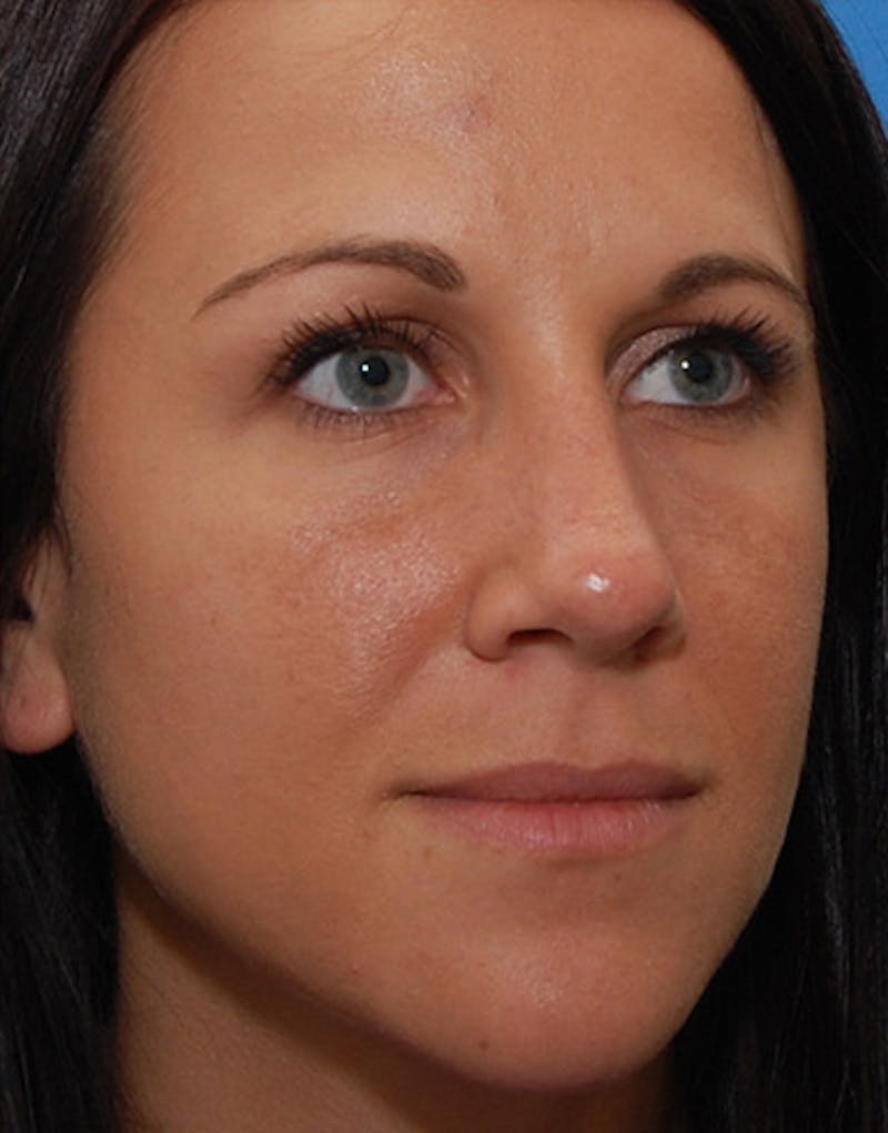 Revision Rhinoplasty Before & After Gallery - Patient 679234 - Image 6