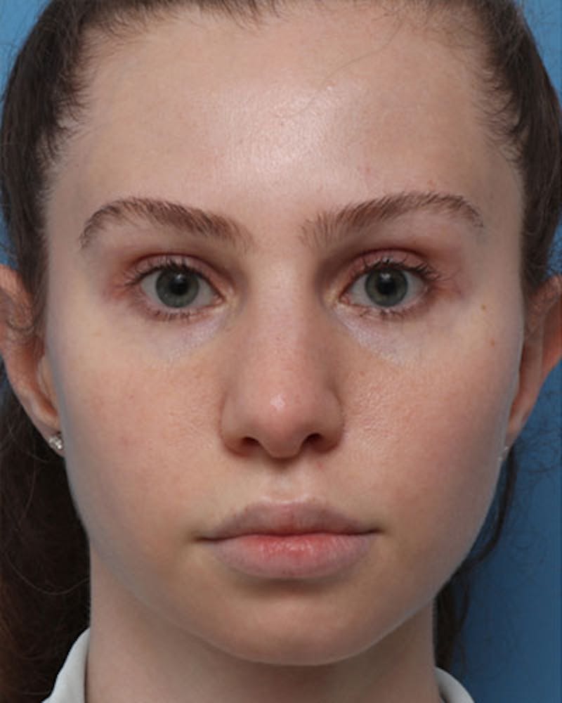 Rhinoplasty Before & After Gallery - Patient 330443 - Image 3