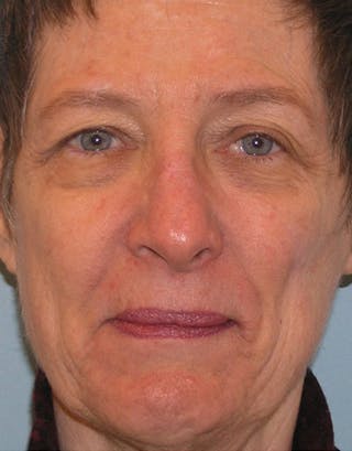 Rhinoplasty Before & After Gallery - Patient 191046 - Image 2