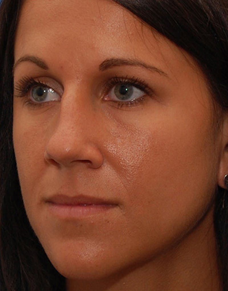 Revision Rhinoplasty Before & After Gallery - Patient 679234 - Image 7