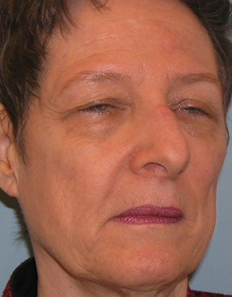 Rhinoplasty  Before & After Gallery - Patient 191046 - Image 3