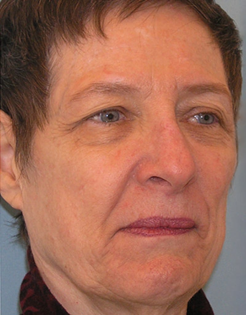 Rhinoplasty  Before & After Gallery - Patient 191046 - Image 4