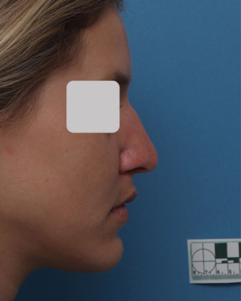 Patient HvfFtFx7TSWWGlIPMsutAw - Rhinoplasty Before & After Photos