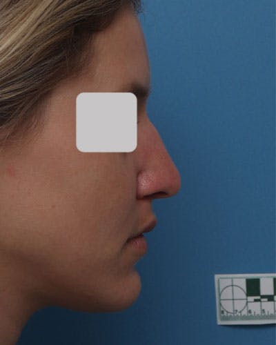 Rhinoplasty Before & After Gallery - Patient 363016 - Image 1