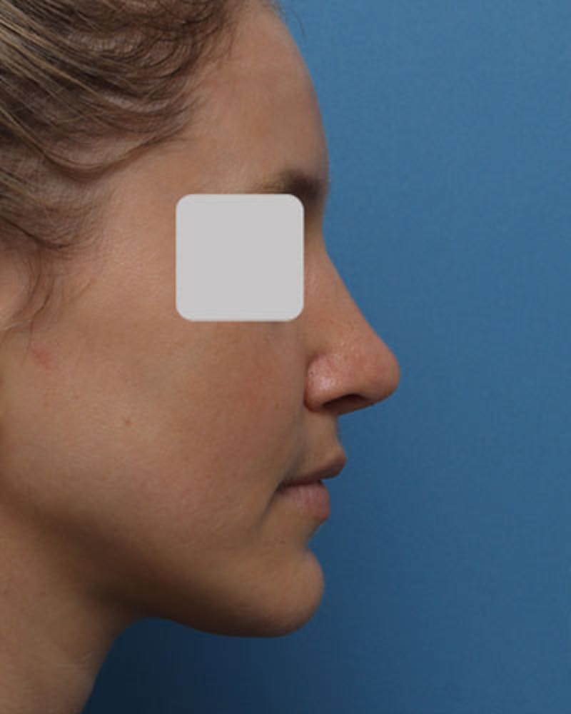 Rhinoplasty Before & After Gallery - Patient 160406 - Image 2
