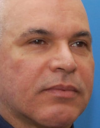 Rhinoplasty Before & After Gallery - Patient 324447 - Image 8