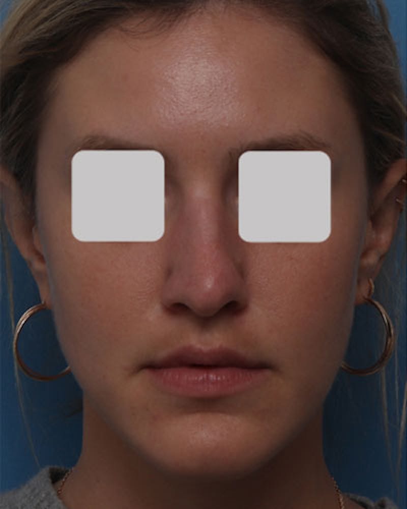 Rhinoplasty Before & After Gallery - Patient 160406 - Image 3