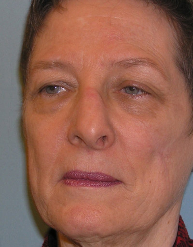 Rhinoplasty  Before & After Gallery - Patient 191046 - Image 5