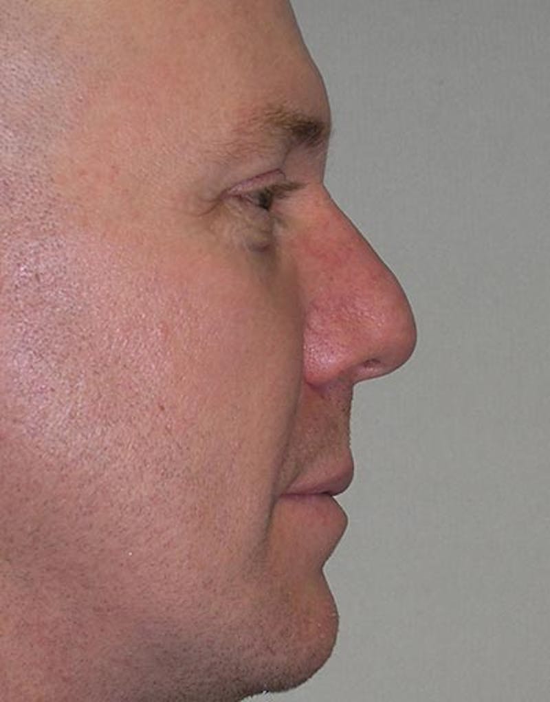 Patient OqU_ZPjhSpifmYHlfLqPJg - Male Rhinoplasty Before & After Photos