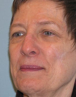 Rhinoplasty Before & After Gallery - Patient 191046 - Image 6