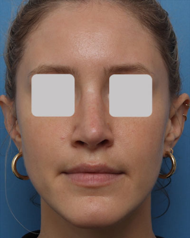Rhinoplasty Before & After Gallery - Patient 160406 - Image 4