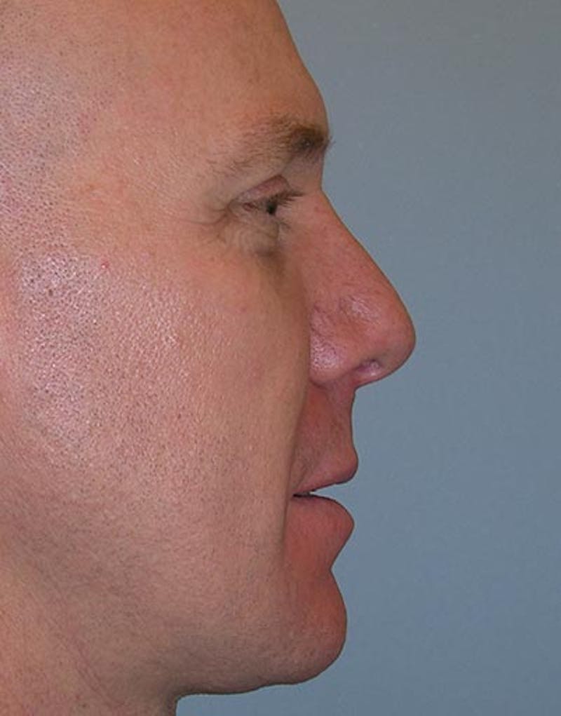 Male Rhinoplasty Before & After Gallery - Patient 381063 - Image 2