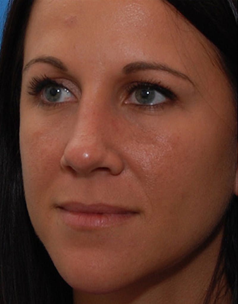 Revision Rhinoplasty Before & After Gallery - Patient 679234 - Image 8