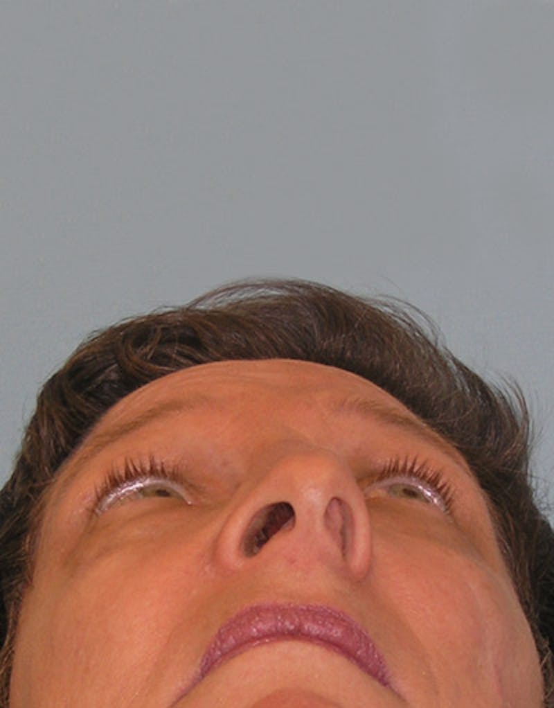 Rhinoplasty  Before & After Gallery - Patient 191046 - Image 7