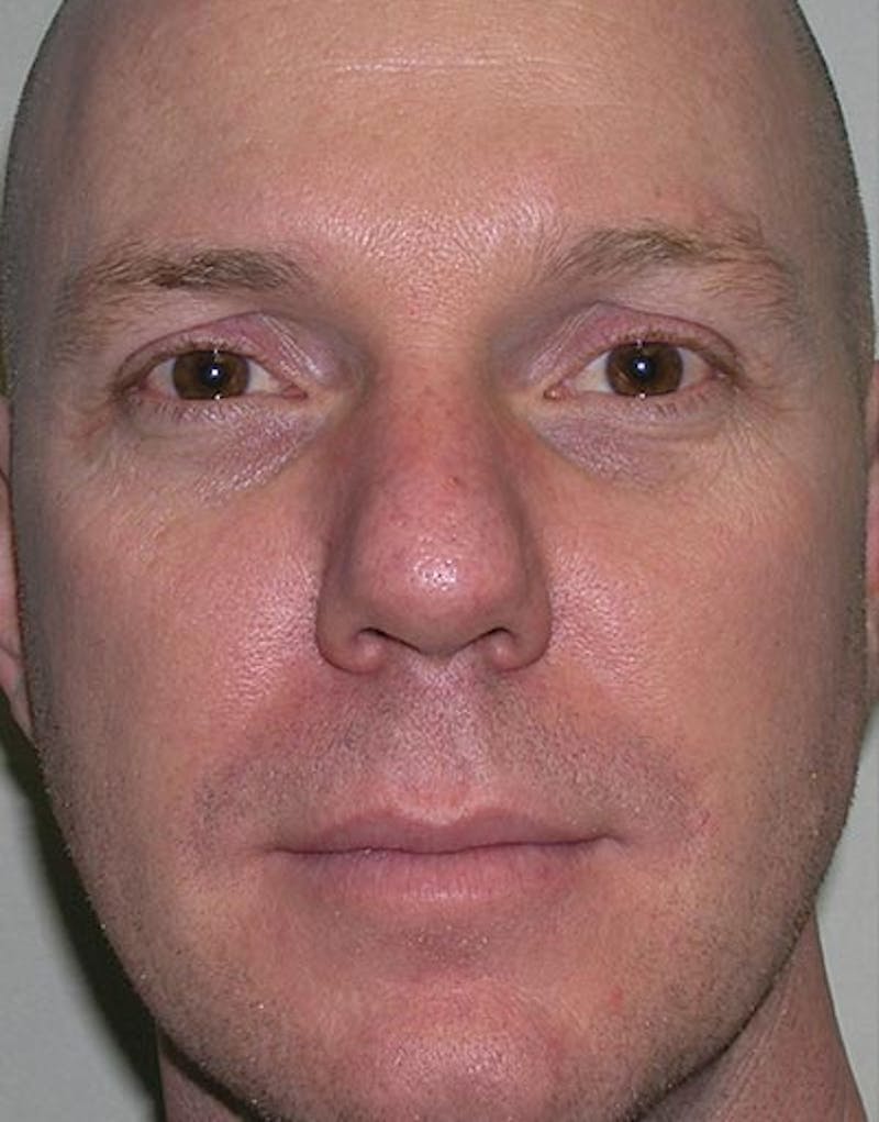Male Rhinoplasty Before & After Gallery - Patient 381063 - Image 3
