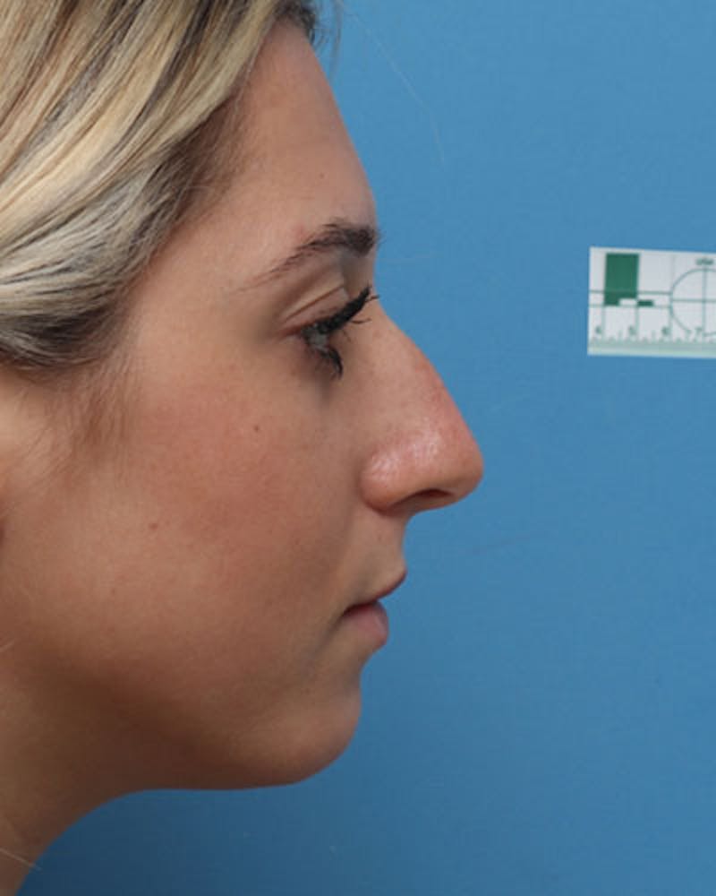Rhinoplasty Before & After Gallery - Patient 158012 - Image 1