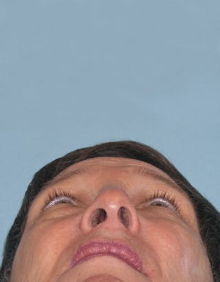 Rhinoplasty Before & After Gallery - Patient 191046 - Image 8