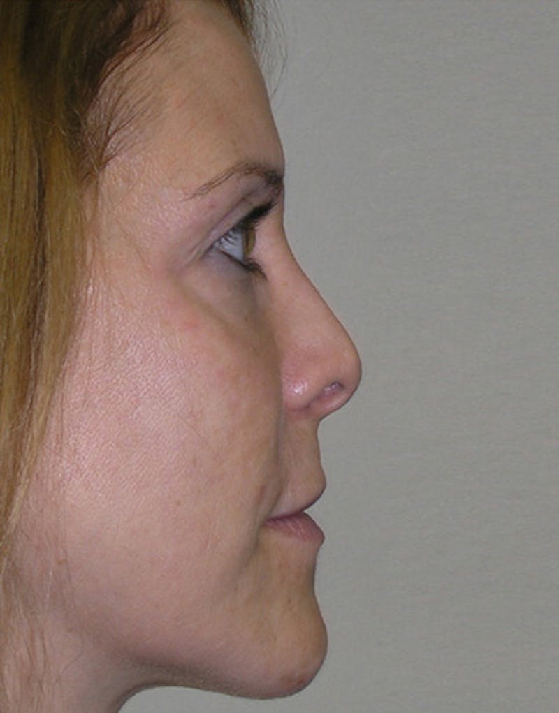 Patient QI1BCfDaRNGXtZ-2FMI5RQ - Revision Rhinoplasty Before & After Photos