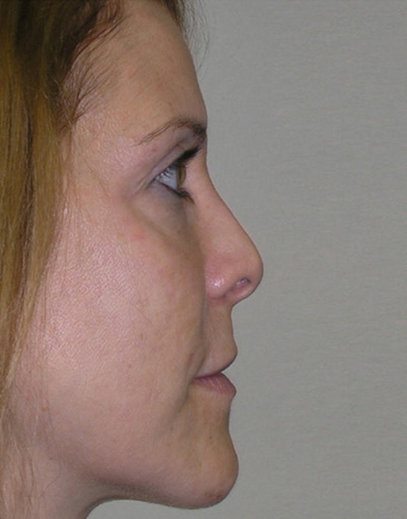 Revision Rhinoplasty Before & After Gallery - Patient 365998 - Image 1
