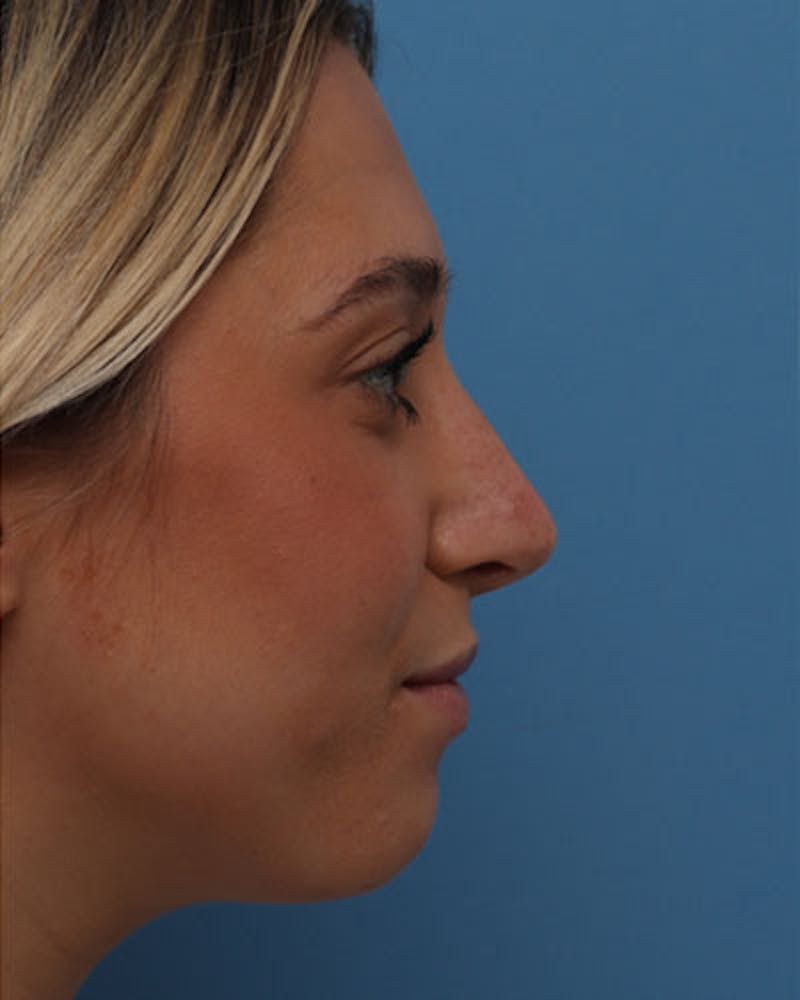 Rhinoplasty Before & After Gallery - Patient 158012 - Image 2