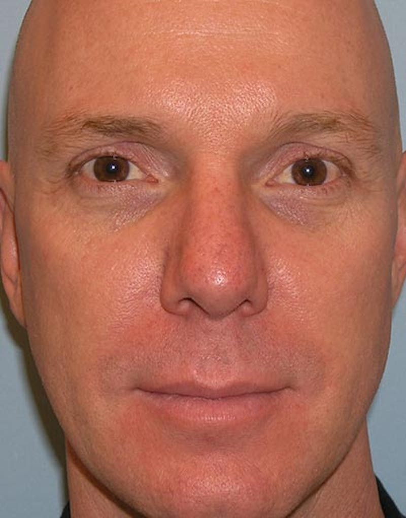 Male Rhinoplasty Before & After Gallery - Patient 381063 - Image 4