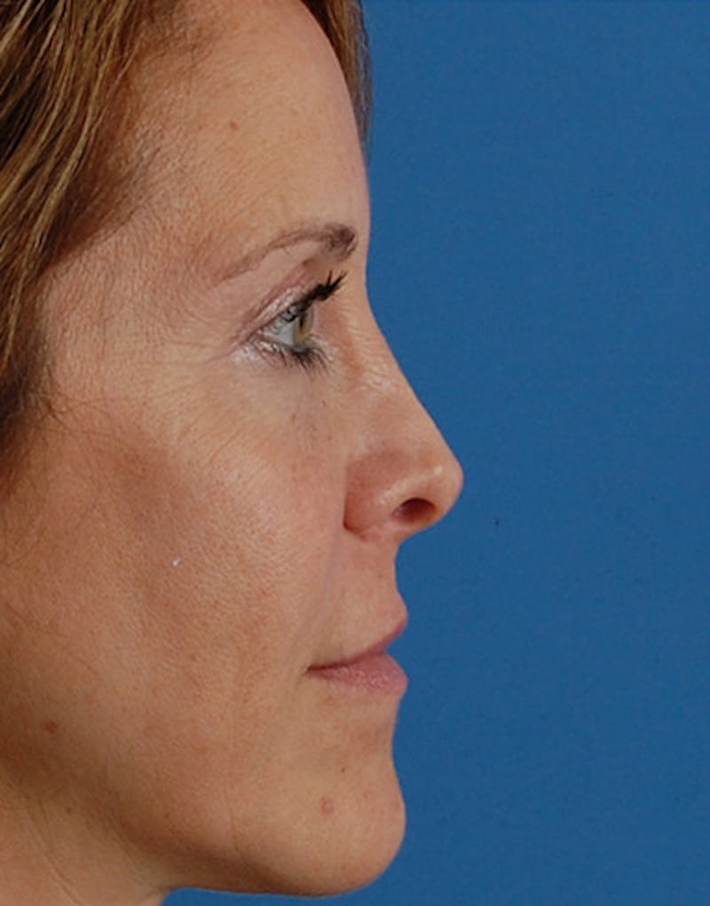 Revision Rhinoplasty Before & After Gallery - Patient 365998 - Image 2