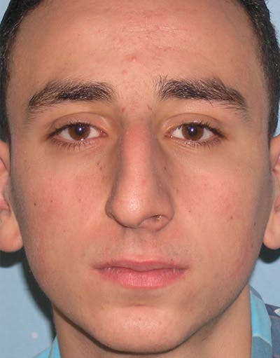 Rhinoplasty Before & After Gallery - Patient 394307 - Image 1