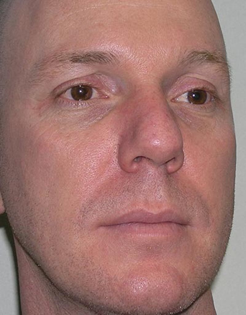 Rhinoplasty  Before & After Gallery - Patient 181137 - Image 5