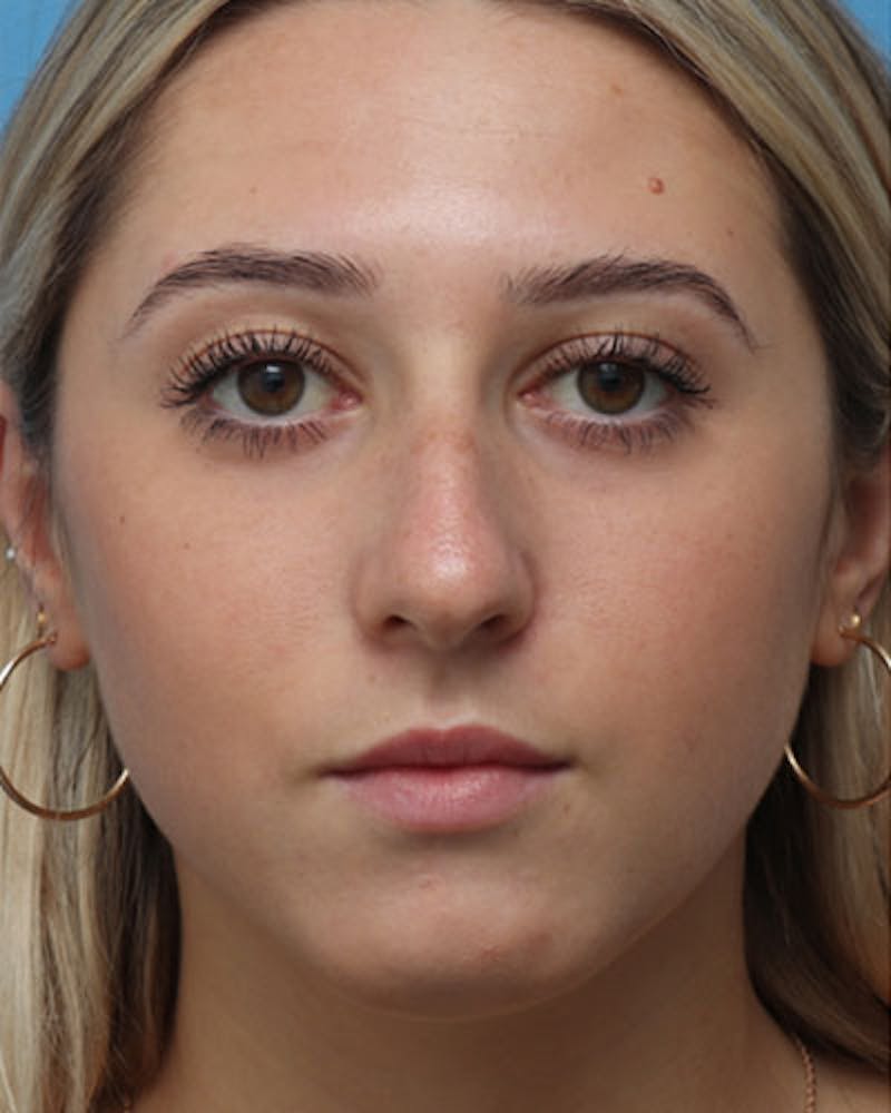 Rhinoplasty Before & After Gallery - Patient 158012 - Image 3