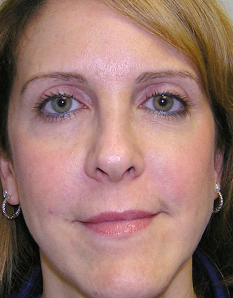 Revision Rhinoplasty Before & After Gallery - Patient 365998 - Image 3