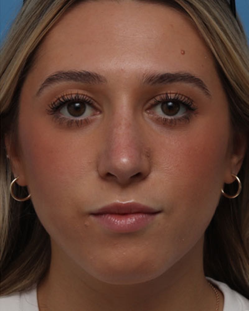 Rhinoplasty Before & After Gallery - Patient 158012 - Image 4