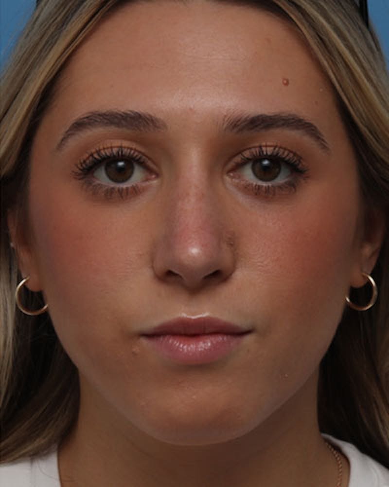 Rhinoplasty  Before & After Gallery - Patient 139797 - Image 4