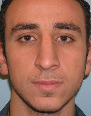 Rhinoplasty Before & After Gallery - Patient 394307 - Image 2