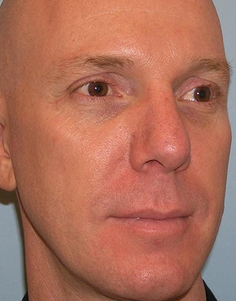 Rhinoplasty  Before & After Gallery - Patient 181137 - Image 6