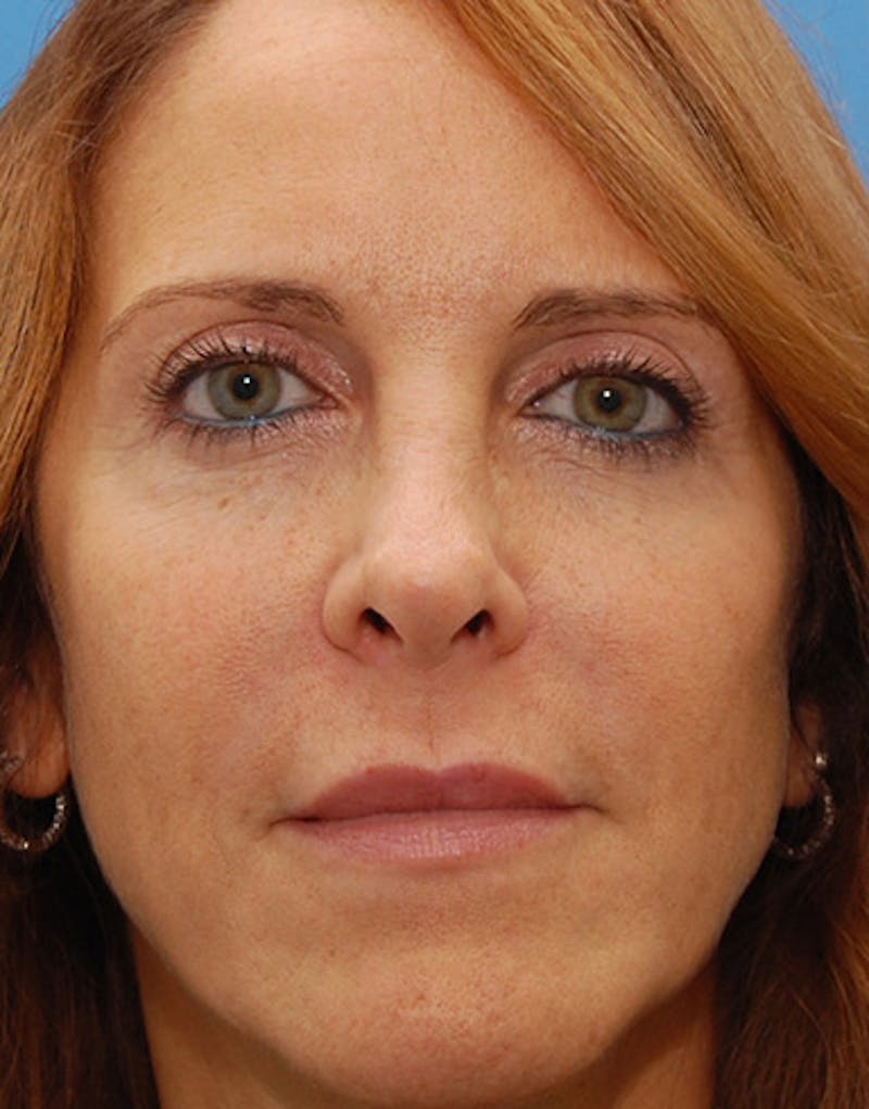 Revision Rhinoplasty Before & After Gallery - Patient 365998 - Image 4