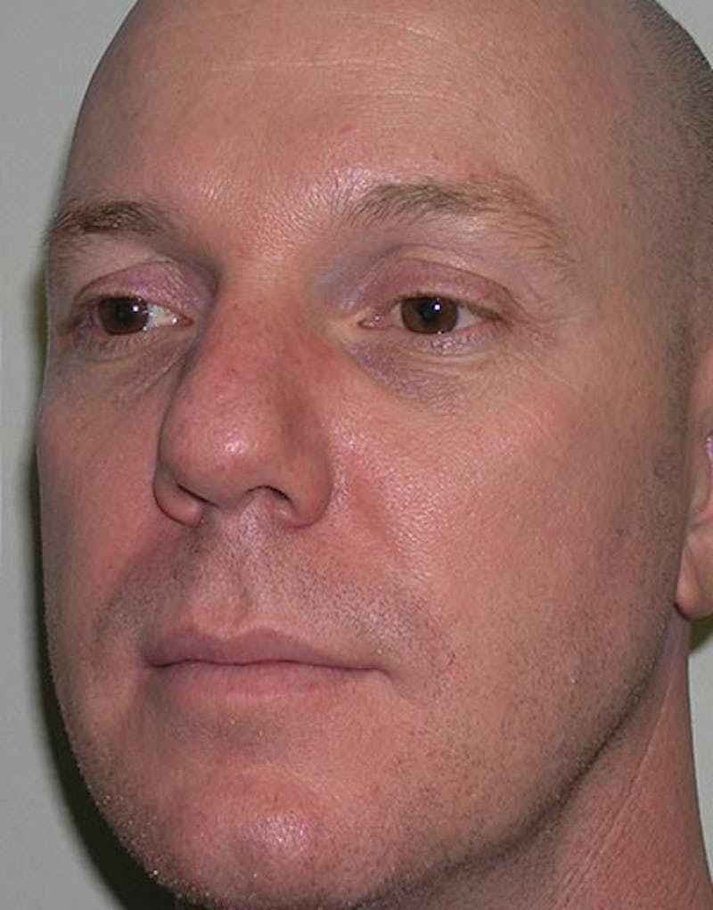 Rhinoplasty  Before & After Gallery - Patient 181137 - Image 7