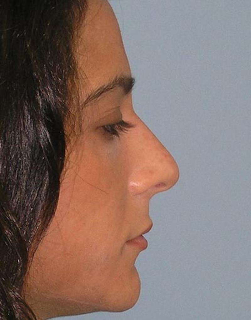 Rhinoplasty Before & After Gallery - Patient 335069 - Image 1