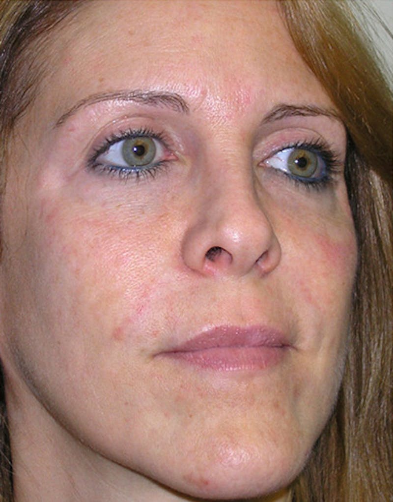 Rhinoplasty  Before & After Gallery - Patient 426670 - Image 5