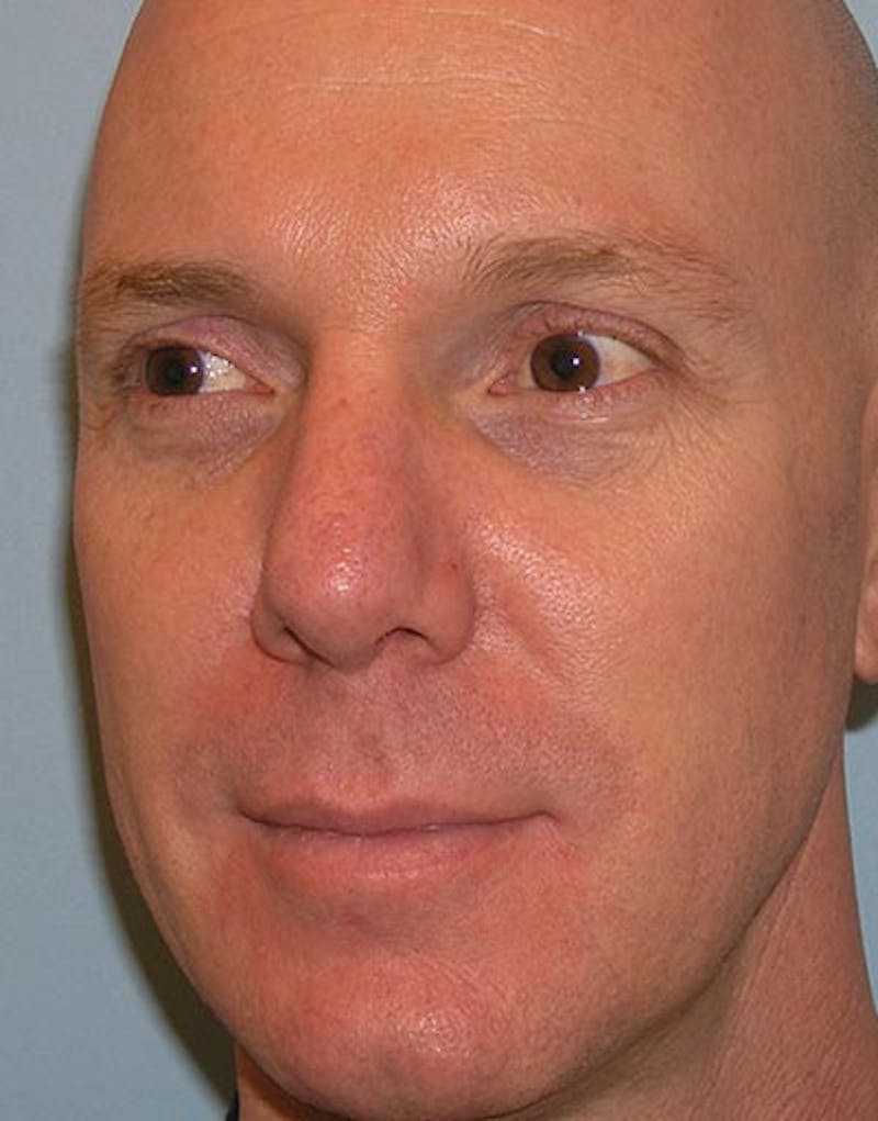 Rhinoplasty  Before & After Gallery - Patient 181137 - Image 8