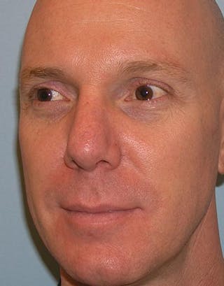 Rhinoplasty Before & After Gallery - Patient 181137 - Image 8