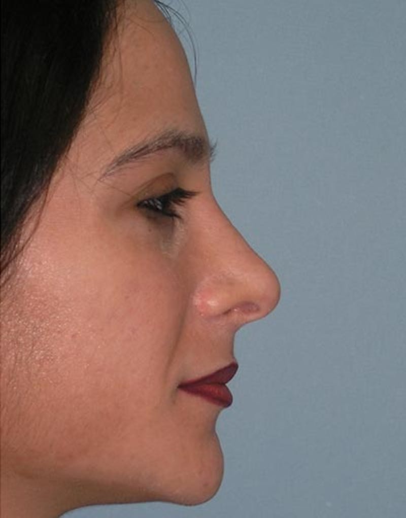 Rhinoplasty Before & After Gallery - Patient 335069 - Image 2