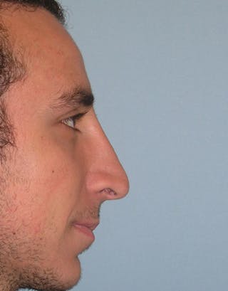 Rhinoplasty Before & After Gallery - Patient 394307 - Image 4
