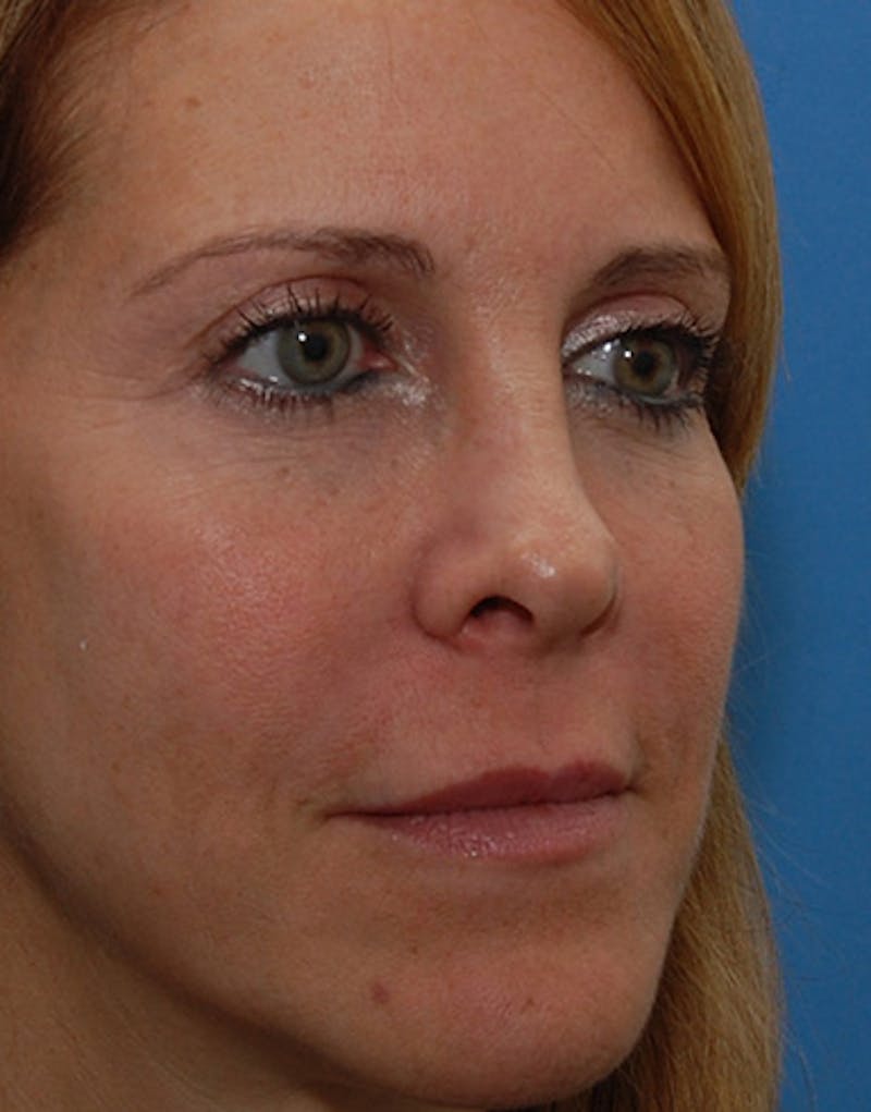 Revision Rhinoplasty Before & After Gallery - Patient 365998 - Image 6