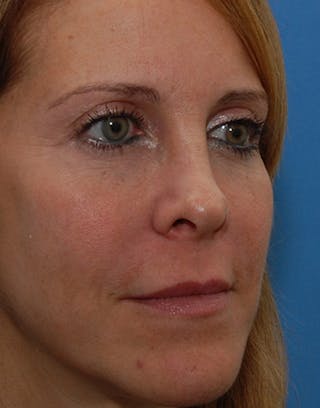 Rhinoplasty Before & After Gallery - Patient 426670 - Image 6