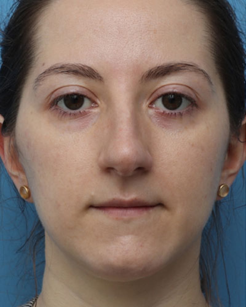 Patient LMTWS9xhTzmoVSES0C8Upg - Rhinoplasty Before & After Photos