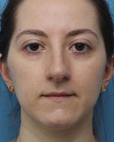 Rhinoplasty Before & After Gallery - Patient 289173 - Image 1
