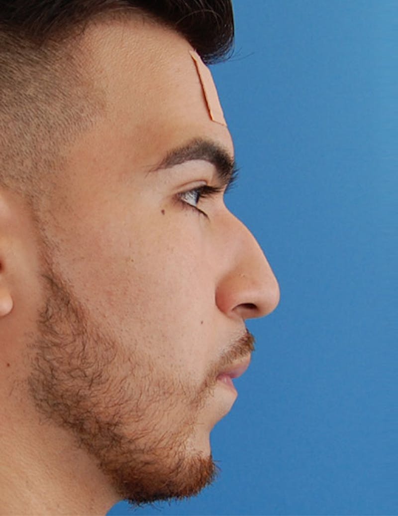 Male Rhinoplasty Before & After Gallery - Patient 174465 - Image 1