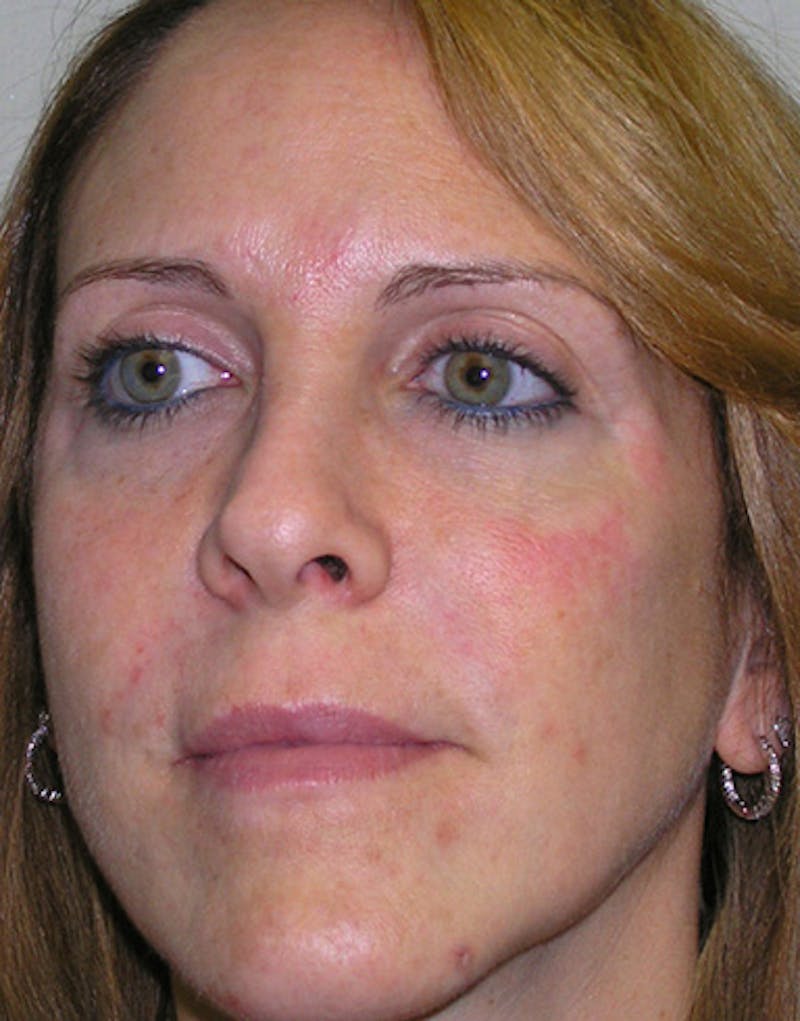 Revision Rhinoplasty Before & After Gallery - Patient 365998 - Image 7